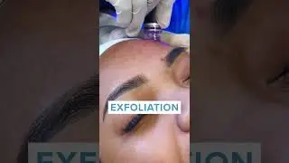 Facial Hydrafacial (extraction) - A popular skin treatment at Clinique Evolution