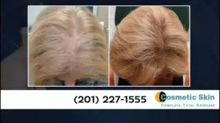 Hair Loss Restoration in New Jersey | Dr. Jeffrey Rapaport 201-227-1555