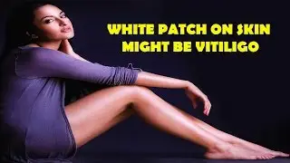 White Patch On Skin