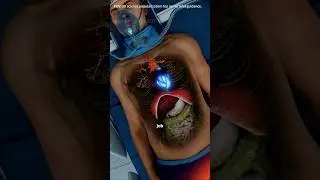 Artificial Heart!#hearttransplant#artificialheart#heartsupport#cardiacassistdevice #biotech