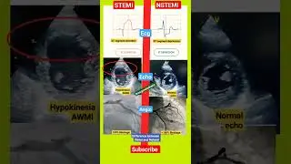 Difference between STEMI ( Heart attack)💔 and NSTEMI by ECG, ECHO, ANGIOGRAPHY #echo #shorts