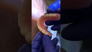 No More Moves your Dentures?!Implants OverDentures#shorts#implants#youtubeshorts #viral