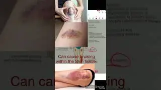 Cushing syndrome in hindi | Pathology | Medicine | nursing