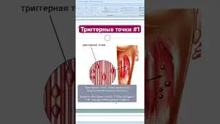 Триггерные точки #1 #триггеры #тт