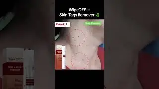 Original Wipeoff Tags & Moles Remover ( not Jaysuing )