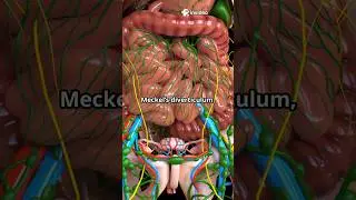 Meckel's diverticulum Rule of 2s #enterography #meckelsdiverticulum #dictogloss #caseseries #adenoma