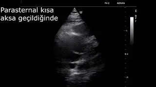 Aort Diseksiyonu - Vaka 2