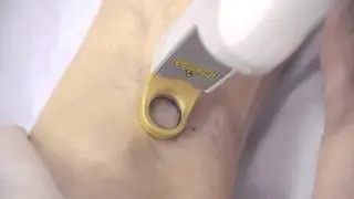 Excel V - Ankle Vein