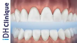 Comblement osseux Bio-Oss pour implant dentaire