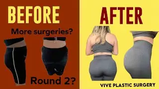 1 YEAR POST OP | Vive Doll | Lifeofjovana