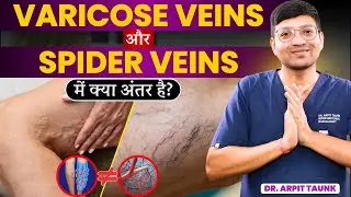 पैरों की नसों में दर्द? Varicose Veins, Spider Veins या DVT | Treatment Without Surgery