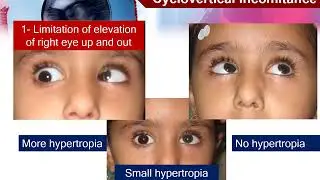 1-3 Motor evaluation of strabismus: Comitant and non-comitant strabismus