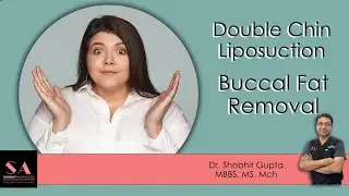 How To Get Chiseled Look? | Buccal Fat Removal | Double Chin Liposuction | Shobhit Aesthetics