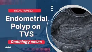 Endometrial Polyp on Transvaginal ultrasound | Radiology case 6