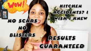 How to treat boiling water burn | Kitchen accidents. The  results is guarantee!
