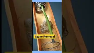 3D Key Hole Stone Removal | #kidneystone #kidneystonetreatment #3danimation #shorts #ytshorts #stone
