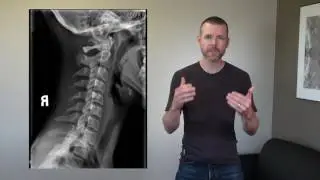 Chiropractor Kalona IA- Jamie's Story
