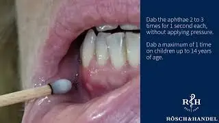 Aphthous ulcer treatment with silver nitrate