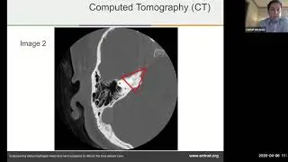 Temporal bone imaging - Dr. Cameron Wick