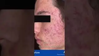 AviClear Laser Acne Treatment: Long-Term Results! (Interview with Dr. Tammy Chen)