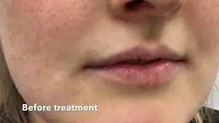 Lip filler results with just 1ml