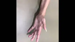 Tendon Transfer To Recover Hand Function