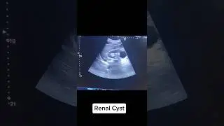 Right Renal Cyst at lower pole of kidney #ultrasound #learnultrasound #kidneyscan #abdominalscan