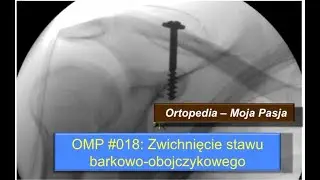 Zwichnięcie stawu barkowo-obojczykowego | OMP#018