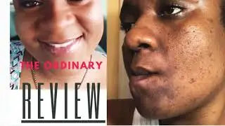 The ordinary |HYPERPIGMENTATION|how to get clean clear skin| two months skincare reviews.