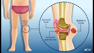 Popliteal Herniation, popliteal cyst, Baker’s cyst; fluid filled sac when synovial fluid herniates