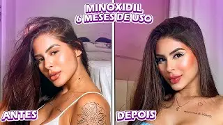 MINOXIDIL (6 MESES DE USO) - EFEITOS COLATERAIS, APLICAÇÃO e +