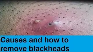 how to remove blackheads