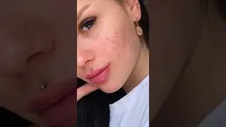 My skin story&hellip; it has been a long battle #acne#acnefighter#acnestory#acnecheck#acneskin#acnescars#s