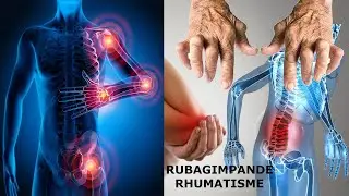 Nubona ibi bimenyetso uzamenye ko RUBAGIMPANDE ikugera amajanja! Sobanukirwa ububi bw' iyi ndwara!