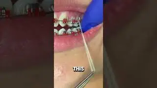 Модели ортодонтических эластиков (резинок) и почему их нужно носить &mdash; Toothtime