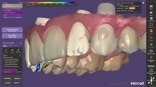 Enceramento Diagn&oacute;stico