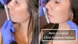 Chin Augmentation With Restylane Defyne at Omaha Cometic Center by Imagen