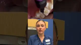 What is a dental sealant? Pediatric dental hygienist explains #dentist #braces #kids