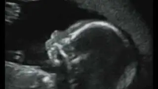 Fetal Medicine Foundation - Micrognathia