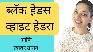 ब्लॅक हेड्स आणि व्हाईट हेड्स कसे दूर करावेत? How to remove Black heads and white heads?