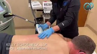 Back laser hair removal treatment