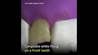artificial cover of teeth
