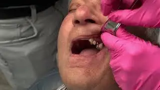 Monday Morning Minute: Mono Implant Instrumentation