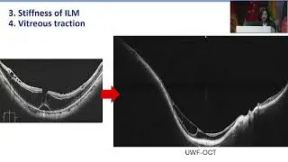 AIOS2025 GP79 T Dr Kyoko OHNO MATSUI First Line Therapy for Myopic Tractional Maculopathy Vitrectomy