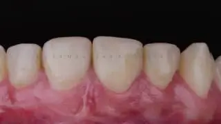 Live patient laminate veneer case