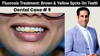 White And Brown Spots On Teeth | Dental Fluorosis Treatment | Dental Case # 9 | Dr. Shahzad Mirza