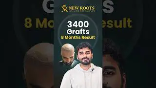 Bangalore Hair Transplant: 8 Months Progress and Density #hairtransplant #bangalore #shorts