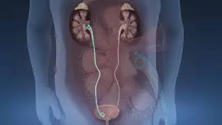 Shock-wave Lithotripsy