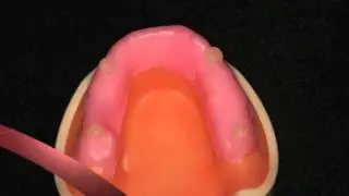 Custom tray fabrication for dental imprssions