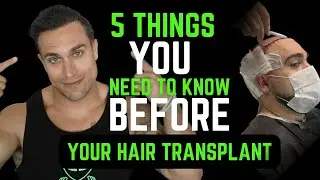 5 Must Knows Before You Get A Hair Transplant Surgery!